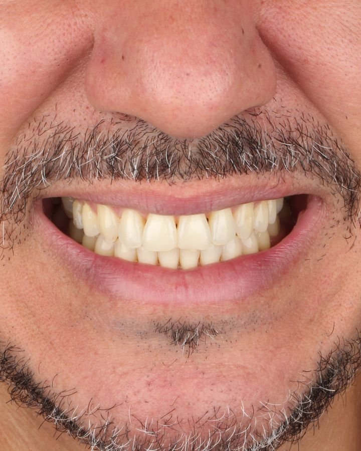 Antes, dentes desgastados e amarelados